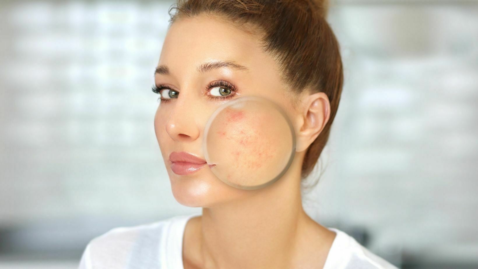 Treating Acne Naturally Sparsh Skin Clinic