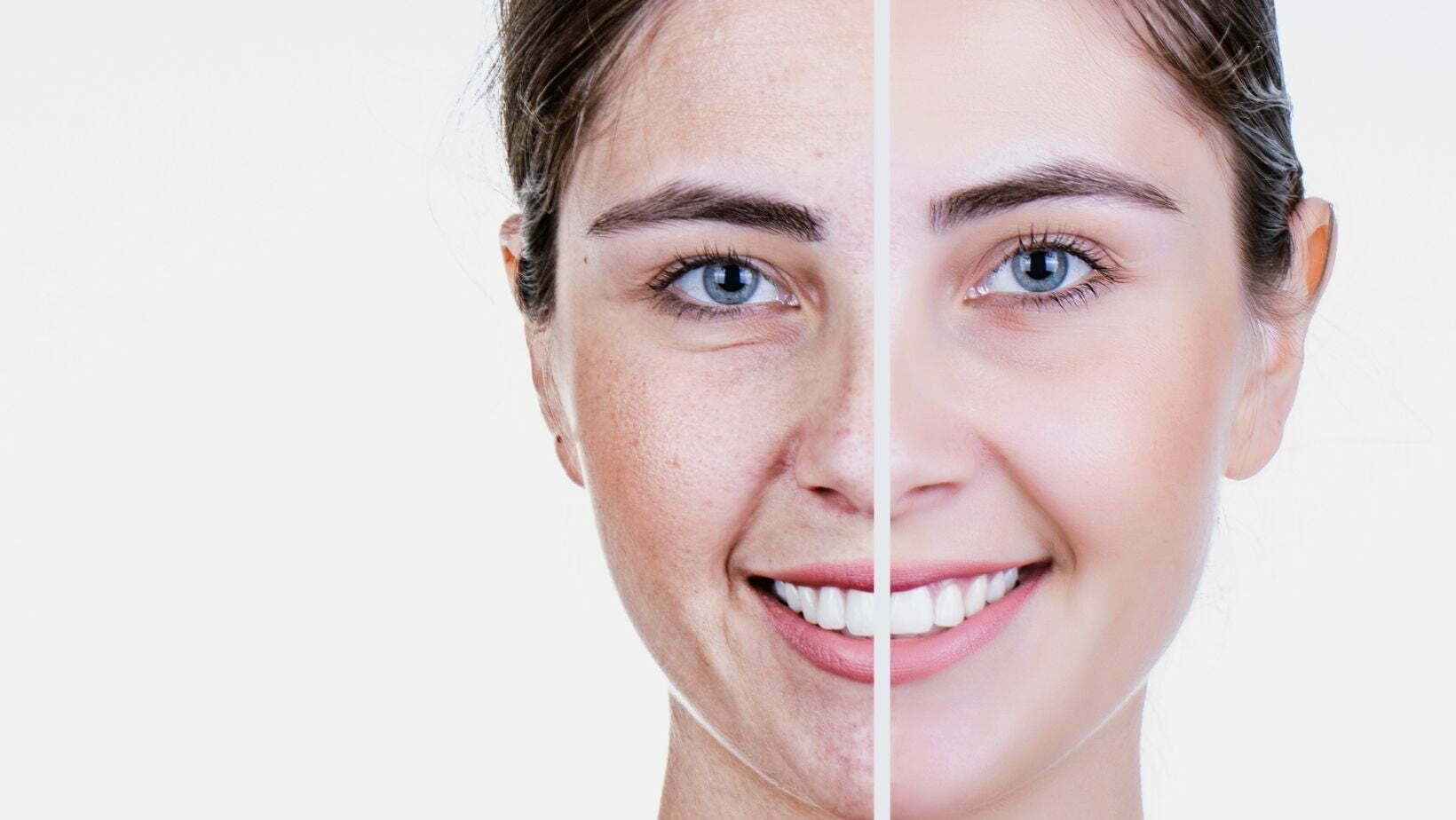 Best AntiAging Skin Care Treatment And Tips Sparsh Skin Clinic