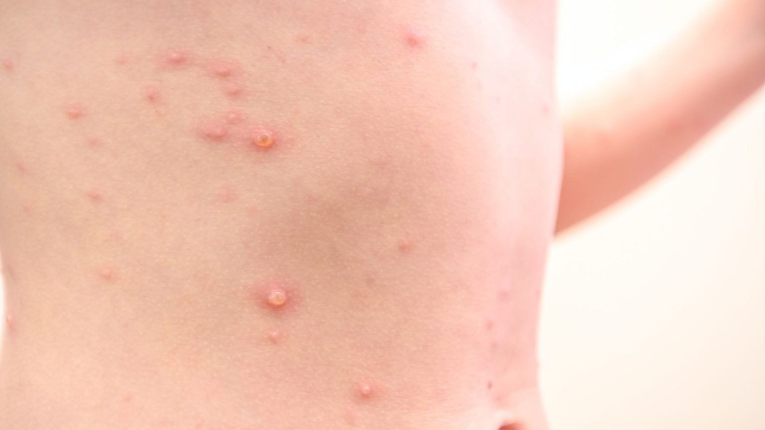 How to Treat Common Skin Infections Treatment - Sparsh Skin Clinic