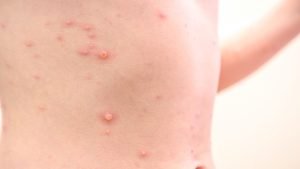 Skin Infections