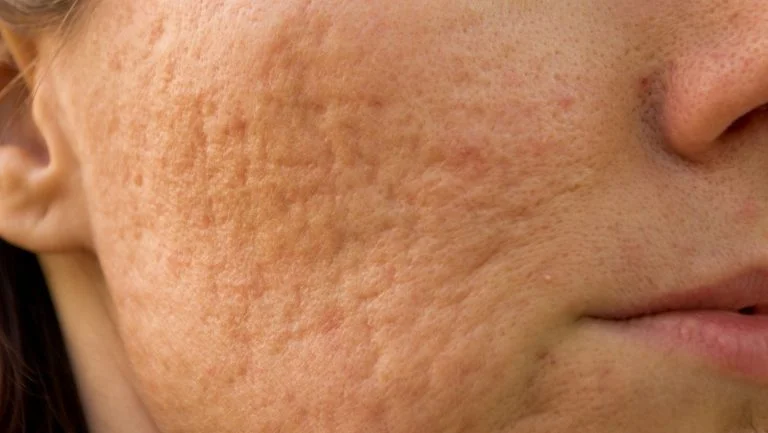 Acne Scars