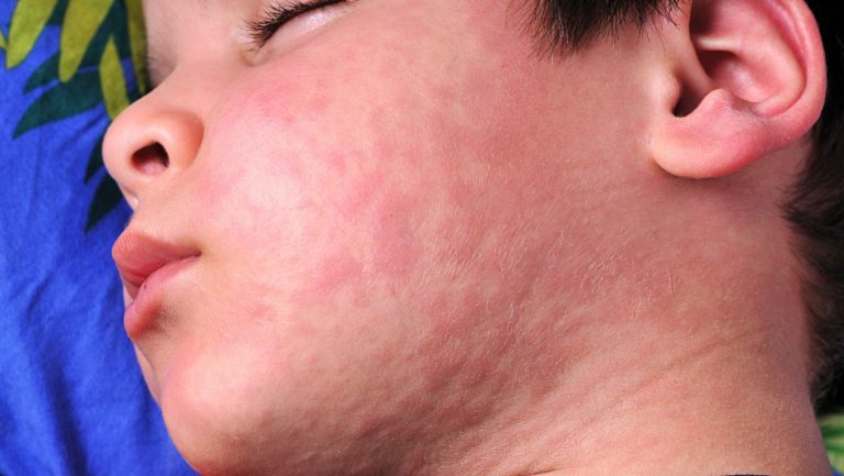 Skin Allergies & Urticaria
