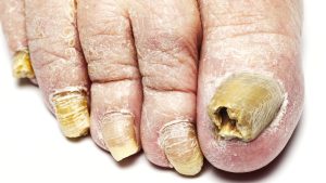 fungal infections