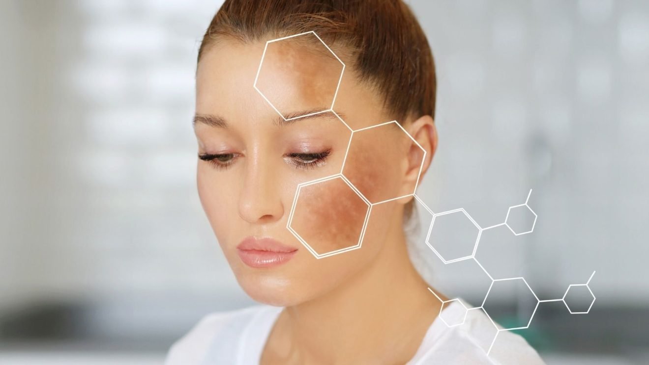 Which laser to do for melasma treatment? Sparsh Skin Clinic