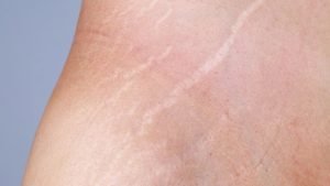 stretch marks