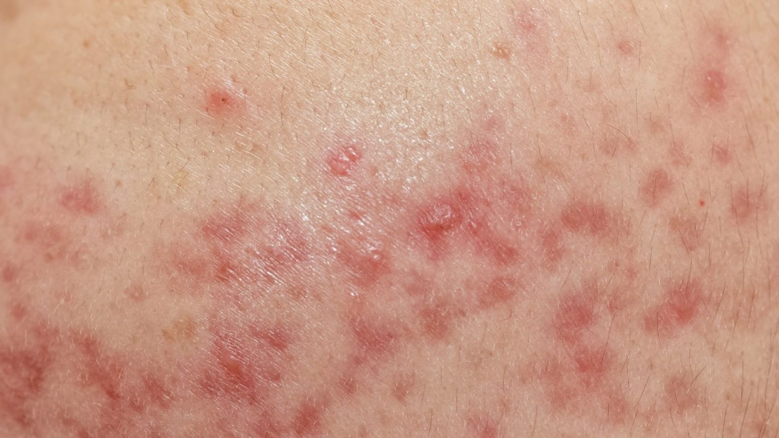 Cystic Acne And Pimples Treatment What To Do? Sparsh Skin Clinic