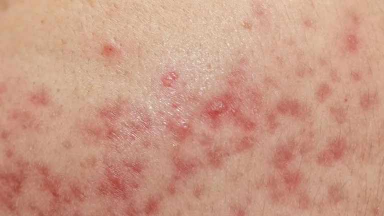 Cystic Acne