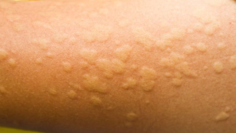 Urticaria and Allergies