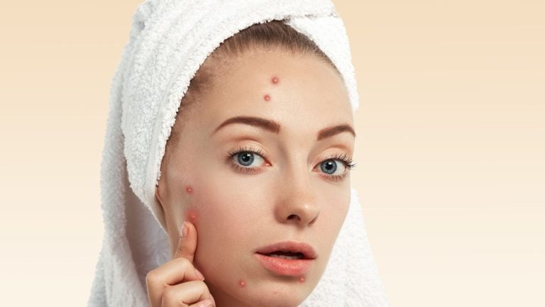 Acne in adult