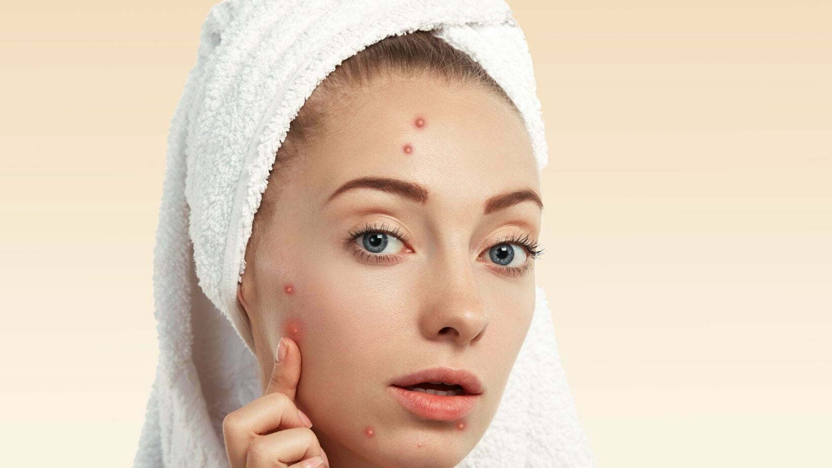 Why Acne Treatment in Adults and 30-40 Years Old? - Sparsh Skin Clinic