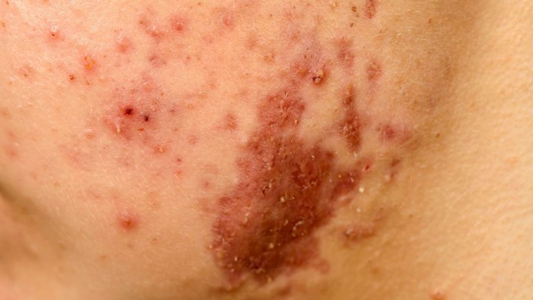 brown acne scar