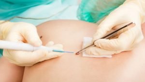 mole removal surgery