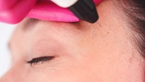 xanthelasma treatment