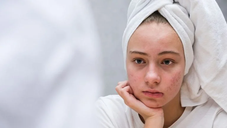 Hormonal Acne