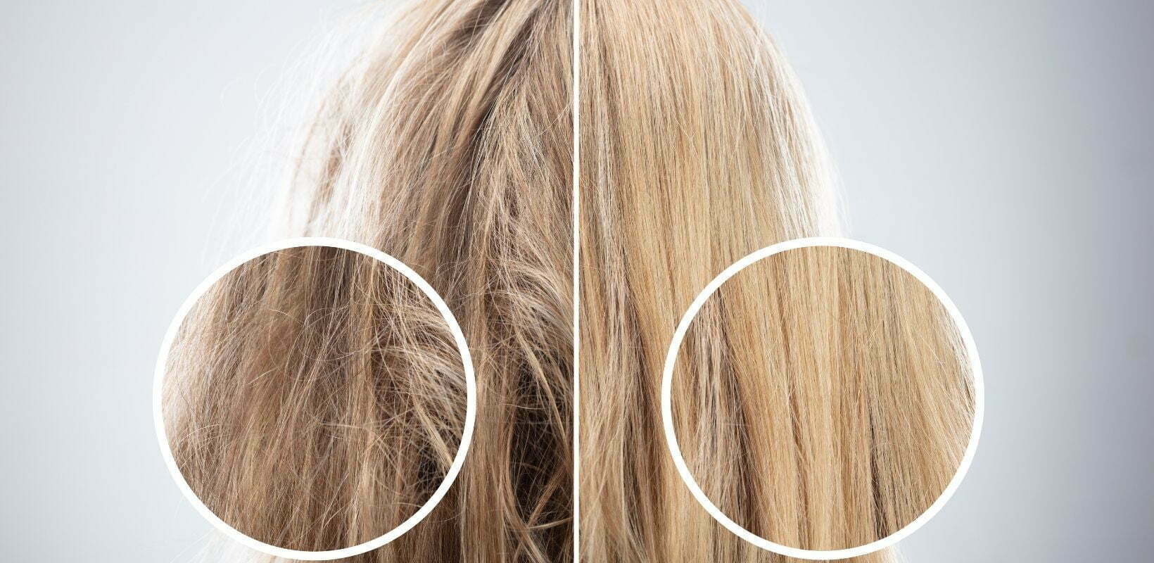 Excess Hair Growth and Hirsutism