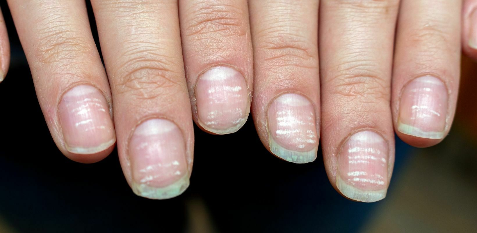 Nail Problems