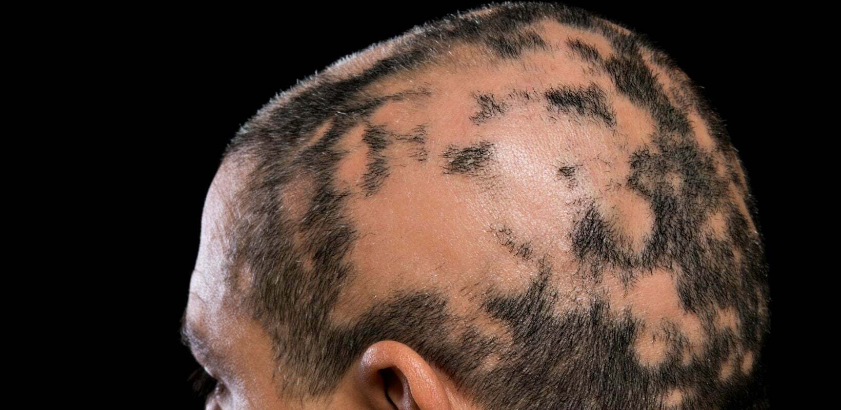 Patchy Alopecia