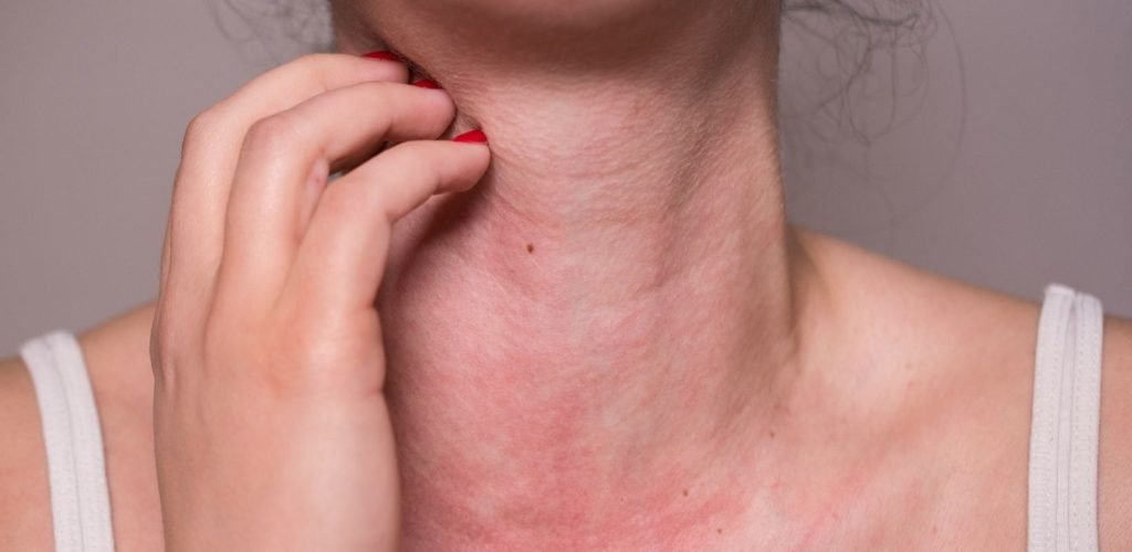 Allergies and Urticaria