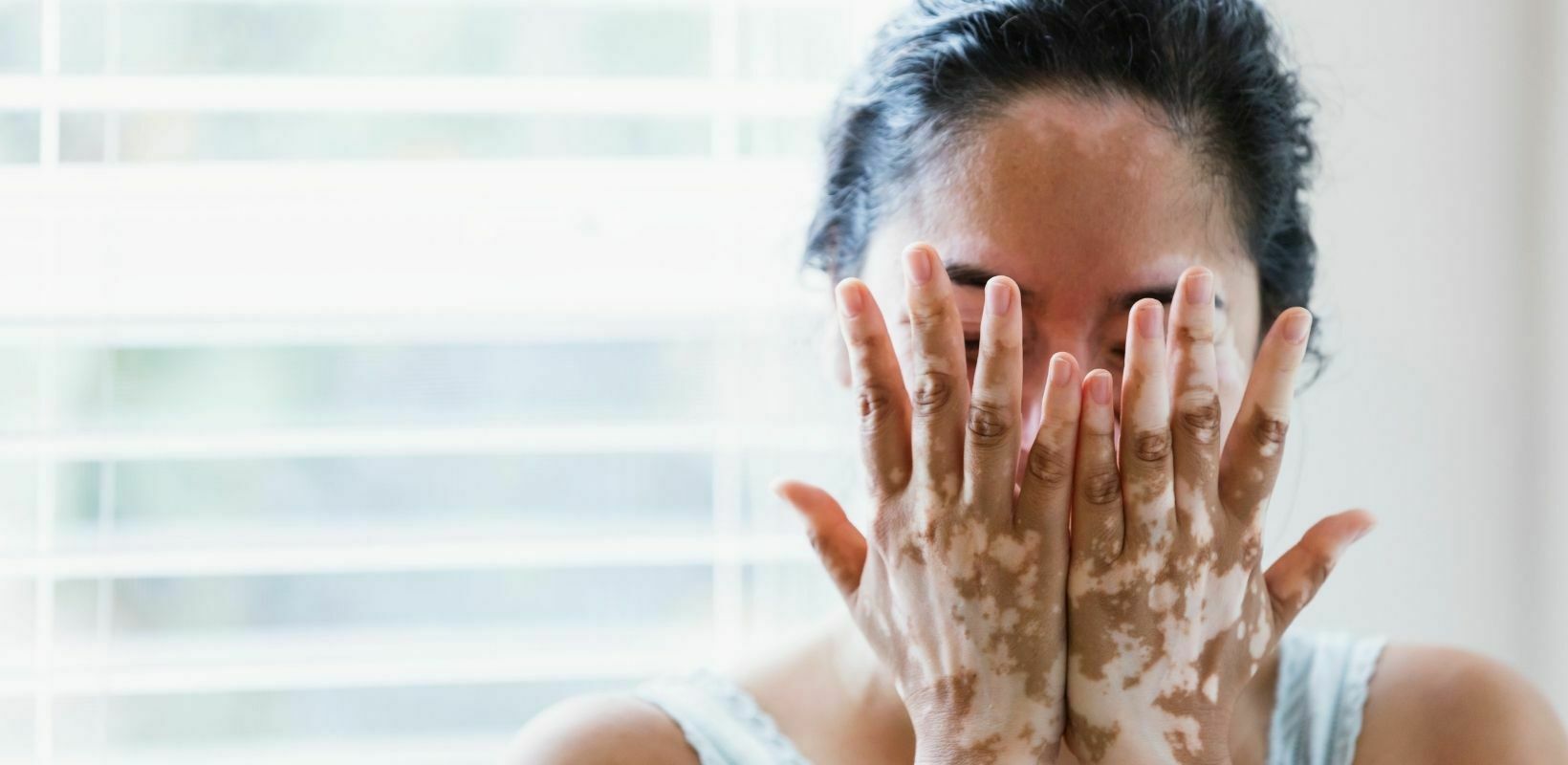 Vitiligo: White spot Disease