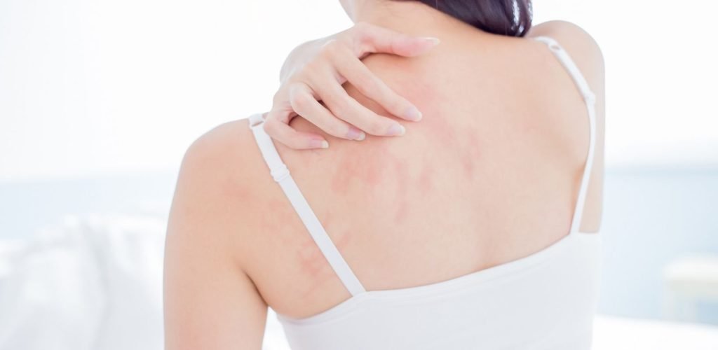 Atopic dermatitis and Eczema