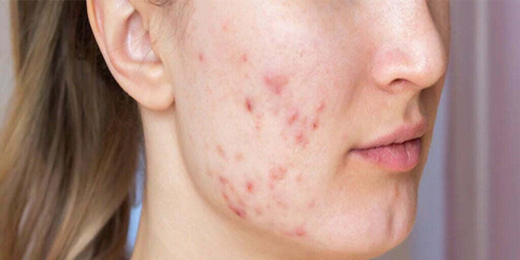 Concerns - Sparsh Skin Clinic