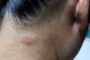 Fungal Infection (2)