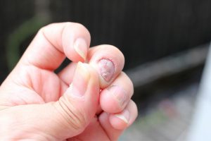 Fungal Infection (5)