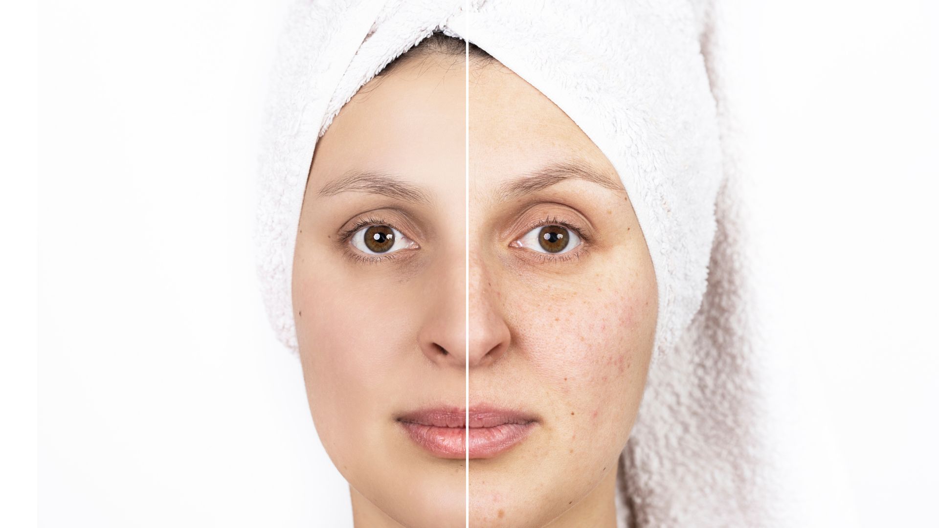 How to Get Rid of Acne Scars The Role of Timely Treatment and Finding
