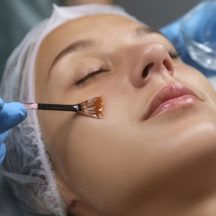 Time Bright (Fillerina) or Succinic Acid and Azelaic Acid Peels for Acne and Pigmentation Treatment: A Guide to Sequential Peels